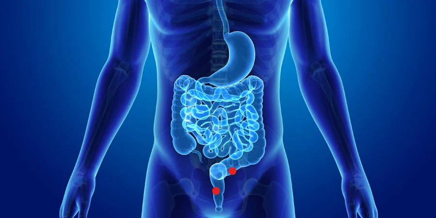cancer-colon-1